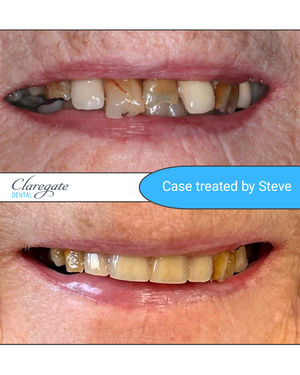 Smile transformation for one Steve' patients with an aesthetic denture.