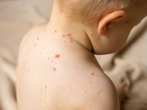 Supporting image for story: Dan Morris: Ready to battle the itchiest of itches