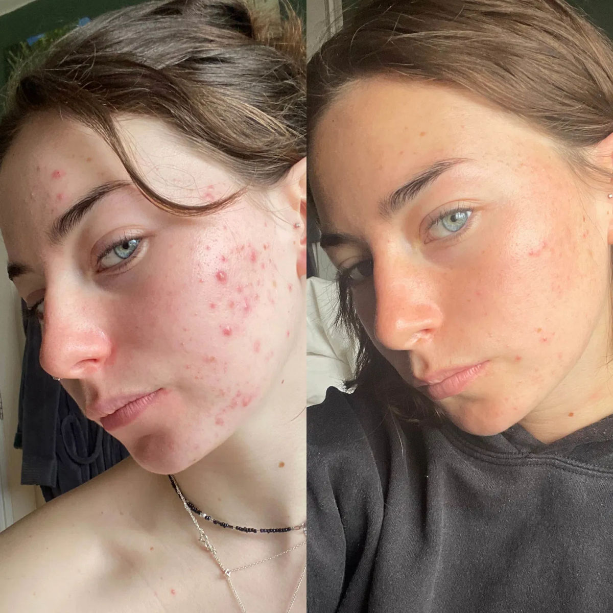 Customers share amazing before and after results of skincare brand that took the world by storm