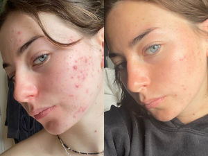 Supporting image for story: Customers share amazing before and after results of skincare brand that took the world by storm