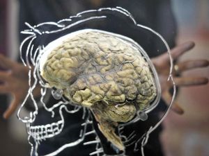 Supporting image for story: Tracking brain iron levels ‘could be helpful for early Parkinson’s diagnosis’