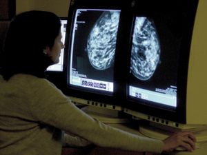 Supporting image for story: AI could detect heart risk from breast screening images, study suggests