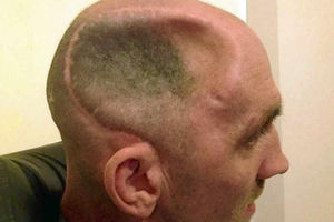 This dramatic picture shows the devastating effects of the injury Mr Taylor suffered to his head which left him brain damaged