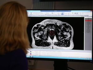 Supporting image for story: One in six prostate cancer deaths ‘could be prevented with targeted screening’