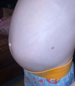 The huge tumour made Dulcie look pregnant. Photo: @dulcies_neuroblastoma_journey