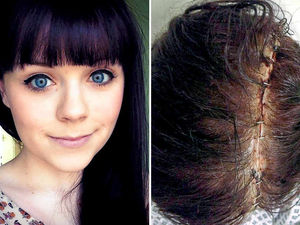 Supporting image for story: Teenager's massive stroke after taking the pill