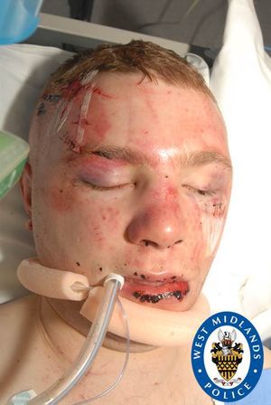 Jason's injuries at the time of the assault in 2015