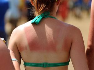 Supporting image for story: 11 unfortunate tweets from people who have already been sunburnt