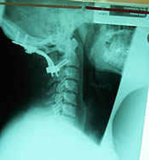 North Staffordshire Hospital in Stoke-on-Trent, led by spinal expert Dr Vinay Jasani, undertook the life-or-death operation which saw two titanium bolts and two bars put in Mr Love's head.