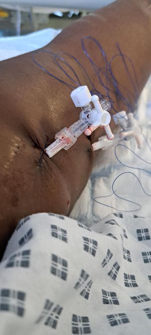Vicky said she went through some 'dark times' before she was able to get a transplant