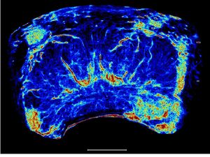 Supporting image for story: New prostate cancer imaging shows ‘extremely encouraging’ results in trials
