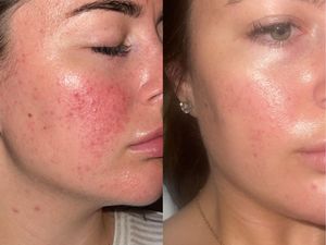 Before and after images of 47 Skin user Jamie