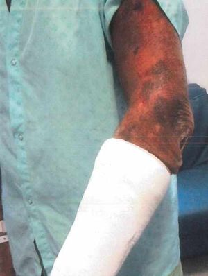 Mr Withers' arm was broken in the attack and required an operation to pin it