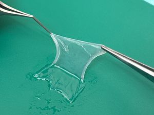 Supporting image for story: Acid attack victim has eye saved by donated placenta