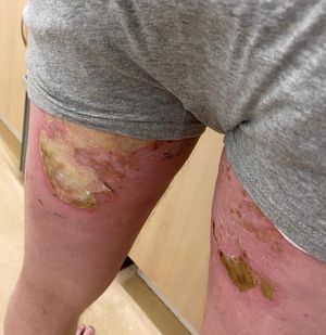 Paul Hickman suffered burns