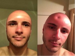 Supporting image for story: Ouch! This guy’s sunburn resulted in some serious swelling