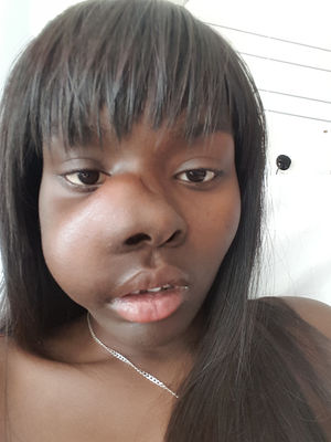 In April 2016, Crystal was diagnosed with osteosarcoma in her upper right jaw at just 18 years old.