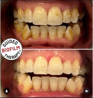 Stain removal with Guided Biofilm Therapy treatment.