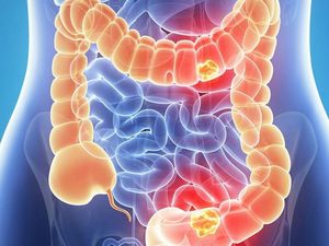 Supporting image for story: Under-50s at increasing risk of bowel cancers, studies suggest