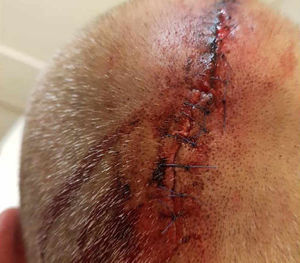 He needed 15 stitches