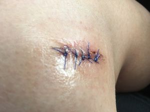 Caroline's knee after surgery