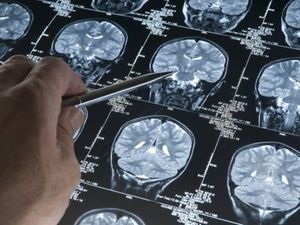 Supporting image for story: Support plea after dramatic five-year rise in dementia cases