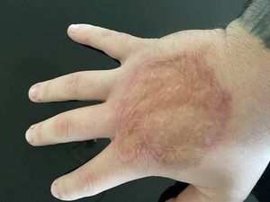 Supporting image for story: Dudley man left with life-changing hand injury after hospital error