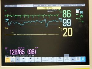 Supporting image for story: No battery required – ‘symbiotic’ pacemaker powered by heartbeats