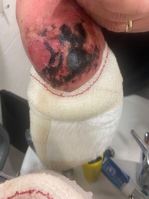 Matt Davies' arm after suffered an electric shock while making lunch 