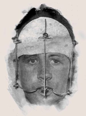 Allan Scott in a head brace after the near-fatal accident