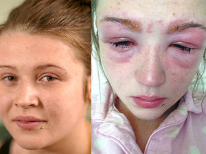 Supporting image for story: Girl, 16, almost blinded in beauty treatment reaction