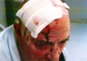 The injuries pensioner Mike Green was left with after the attack