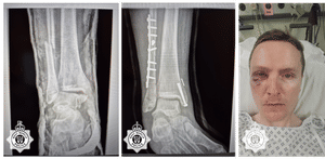 X-rays of PC Davis' broken bones
