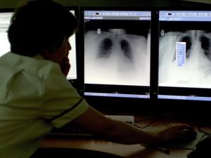 Supporting image for story: Daily pill for lung cancer to be made routinely available on the NHS