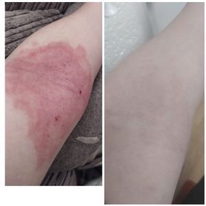 Our goats milk cream after just 10 days transformed this eczema flare up that steroids could not help 