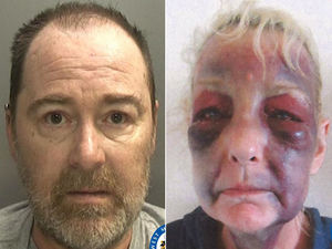 Supporting image for story: 'I thought he was going to kill me': Domestic abuse survivor shows sickening injuries to try to help other victims