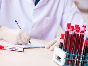 Supporting image for story: Charity calls for change to prostate cancer testing guidelines