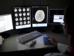 Supporting image for story: ‘Hope on the horizon’ as drugs assessed for Alzheimer’s prevention