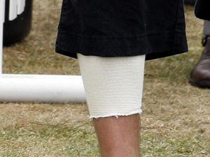 Supporting image for story: Scientists design bandages that can ‘sense and treat bacterial infections’