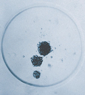 Cancer attempts to spread in a petri dish