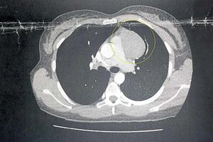 Tests revealed that there was an 8.5cm mass growing in her chest