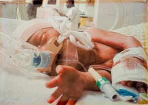 Joshua, in intensive care soon after he was born