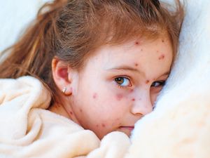 Supporting image for story: MMR jab: Measles and needles in vaccination battle