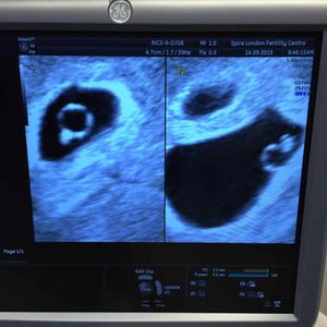 Picture perfect - the scan confirming the couple were expecting twins