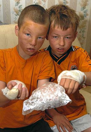 Danny, 11 and Ricky, 10, with burned hands
