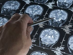 Supporting image for story: Pleas for funding boost as dementia care costs threaten to soar