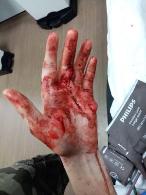 Kaiser's hand after the attack in May