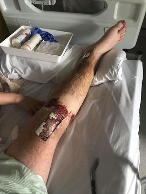 Kai broke his tibia and fibular in the attack