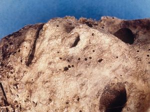 Supporting image for story: Medieval mummy known for having the earliest case of smallpox actually had hepatitis, study shows