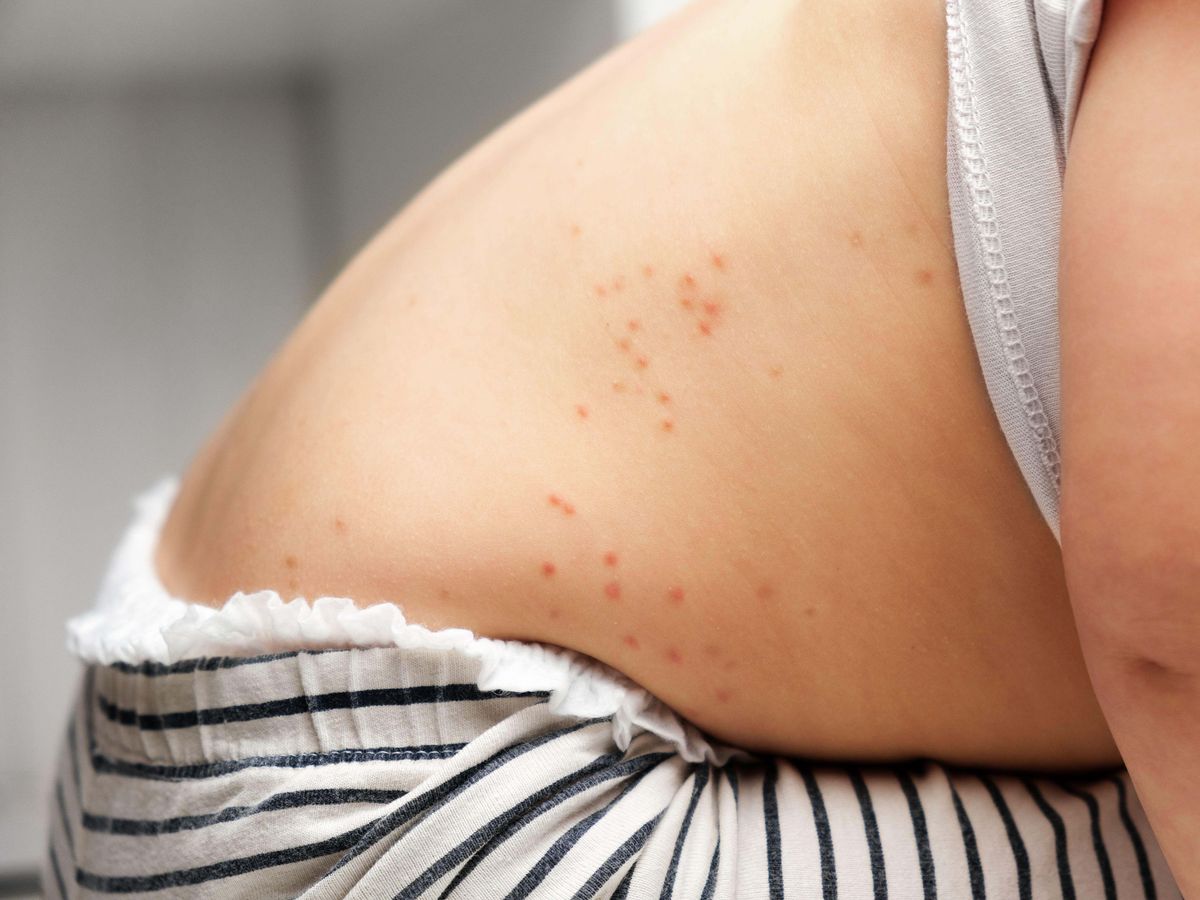 Vaccine for chickenpox to be rolled out on the NHS Vaccine for chickenpox to be rolled out on the NHS